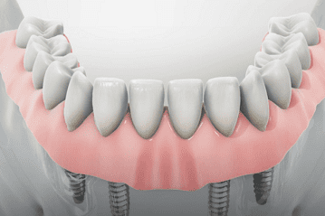 15 Implant Denture