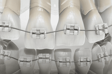 16 Invisible braces