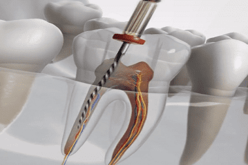 20 Root Canal Treatment
