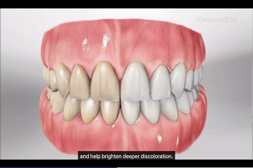 23 Teeth Whitening Home