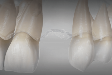 25 Tooth Extraction