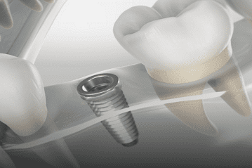 7 Implant