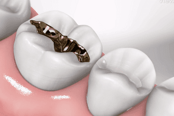 Fillings