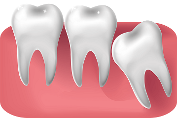 wisdom teeth